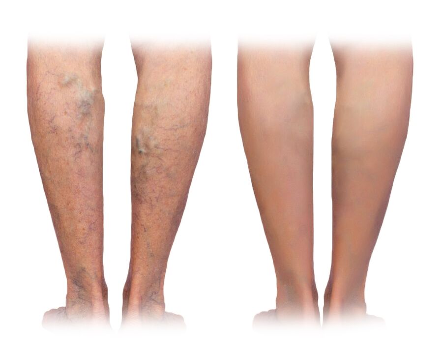 Pernas con varices antes e despois de usar a crema Veniselle