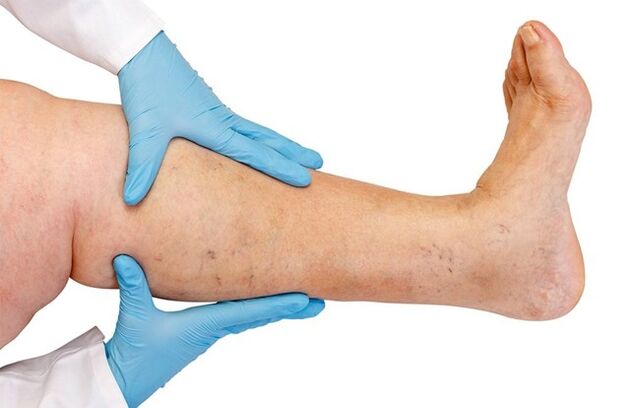 Varices nas pernas